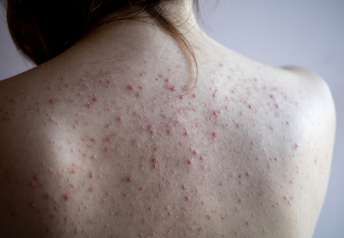 Woman's upper back covered in acne